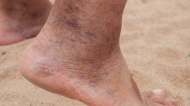 Nasırlar, yaşlı bir adamın ayaklarında nasırlar, bacaklarında şişmiş damarlar.