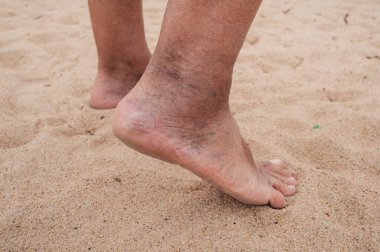 Nasırlar, yaşlı bir adamın ayaklarında nasırlar, bacaklarında şişmiş damarlar.