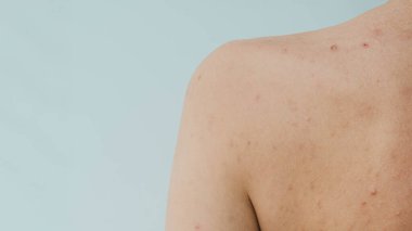 Sivilcelere ve diğer dermatolojik sorunlara yatkın kadın derisinin panoramik bir görüntüsü.