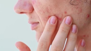 Sivilceli, post-sivilceli sorunlu bir genç kız. Dermatolojik sorunlar.