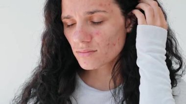 Beyaz tenli, sorunlu bir kızın portresi. Sivilceler, sivilceler, gözenekler, yaralar. Filtresiz hakiki deri..