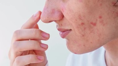 Gri arka planda siyah noktalı beyaz bir genç kız. Kız elleriyle siyah noktalar gösteriyor. Sivilce sorunu, boşalma sorunu. Yüzünde büyümüş gözenekler