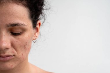 Kırmızı sivilceli yakın deri dokusu, tahriş ve tıkanmış gözenekler cilt bakımıyla ilgili dermatolojik sorunları gösteriyor. Hormonal sivilceler ve yüzündeki lekeler.