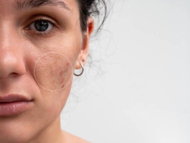 Cilt sorunu olan genç bir kızın yakın çekimi. Sivilceler, sivilceler, gözenekler, yaralar. Filtreli ya da filtresiz doğal deri. Metnin için bir yer