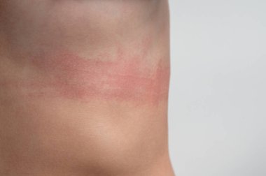 Kadın vücudundaki sütyen izlerinin panoramik görüntüsü. Rahatsız edici bir sutyen. Cesedin üzerinde giysi izleri var. Vücut pozitifliği ve kendini sevme