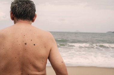 Yaşlı bir adamın sırtında çiller, yaşlanma noktaları, siyah, kahverengi siğiller ve denizin arka planında kırışıklıklar var..