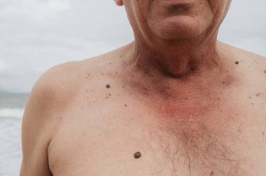 Yaşlı bir adamın derisinin tümörlü hücre kanserini tetikliyor..