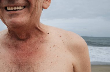 Yaşlı bir adamın cildinde deri dokusu, siyah doğum lekeleri ve benler. Cilt kanseri önleme