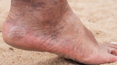 Çıplak erkek ayakları, topuğunda geniş bir nasır ve topuk ve venöz damar genişlemesi.