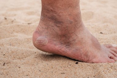 Çıplak erkek ayakları, topuğunda geniş bir nasır ve topuk ve venöz damar genişlemesi.