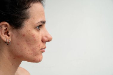 Kırmızı sivilceli yakın deri dokusu, tahriş ve tıkanmış gözenekler cilt bakımıyla ilgili dermatolojik sorunları gösteriyor. Hormonal sivilceler ve yüzündeki lekeler.