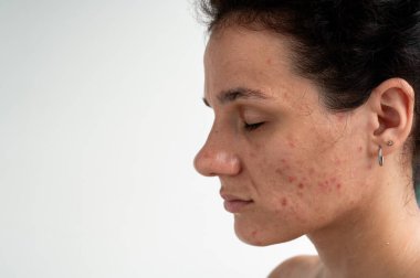 Kırmızı sivilceli yakın deri dokusu, tahriş ve tıkanmış gözenekler cilt bakımıyla ilgili dermatolojik sorunları gösteriyor. Hormonal sivilceler ve yüzündeki lekeler.