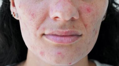 Sorunları olan genç bir kızın derisine yakın çekim. Sivilceler, sivilceler, gözenekler, yaralar. Filtresiz doğal cilt.