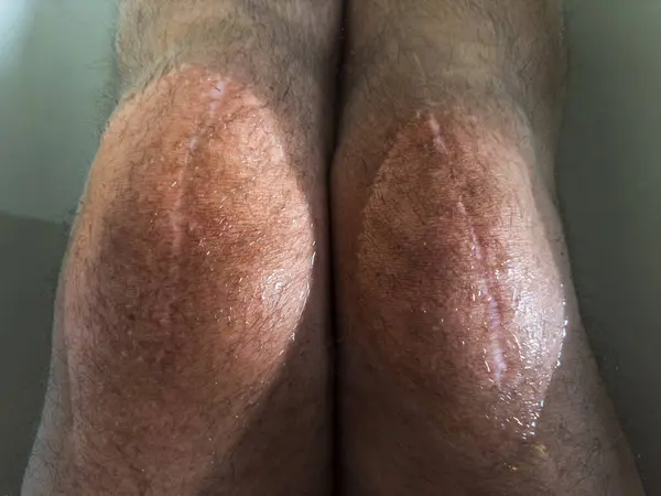 Diz protezi takılmış son sınıf öğrencisi banyoda oturuyor.