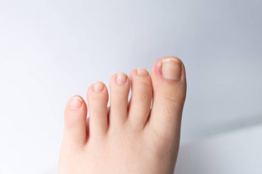 Close-up photo of an ingrown toenail, showing discomfort and potential pain, front view, cropped photo of children feet clipart