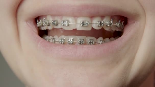 Close Teeth Young Woman Who Smiles Widely All Her Teeth — Wideo stockowe