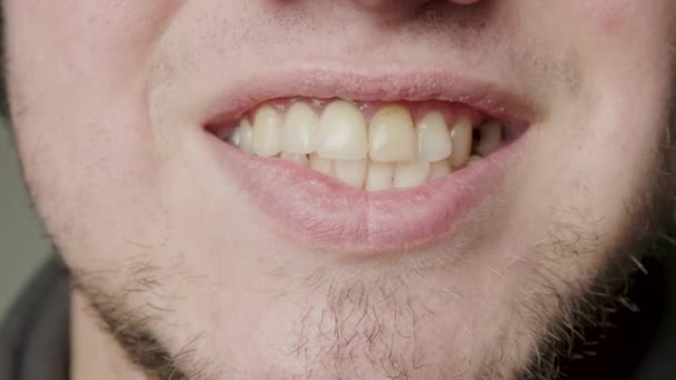 Close Smile Broken Tooth Cavities Dental Problems Stone Teeth Dirty — Αρχείο Βίντεο