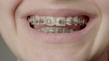 Wide smile of a woman close up. Natural and healthy teeth of a woman who straightens her teeth with metal brackets. Teeth straightening process. Dental and teeth care concept