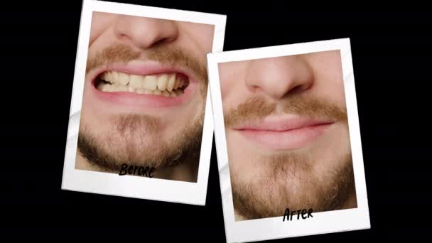 Collage Two Pictures Black Background Mans Teeth Concept Teeth Whitening — Wideo stockowe