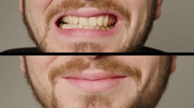 Arka plan olmadan, önce ve sonra, erkek dişleriyle yazmadan üst üste yerleştirilmiş iki resmin kolajı. Diş beyazlatma tedavisi. Diş beyazlatma işleminden sonra gülümseyen adam