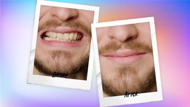 Collage Two Pictures Colored Background Mans Teeth Concept Teeth Whitening — Wideo stockowe
