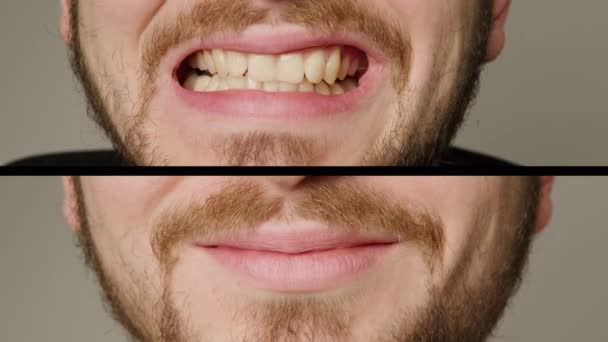 Collage Two Superimposed Pictures Background Writing Mans Teeth Teeth Whitening — Video