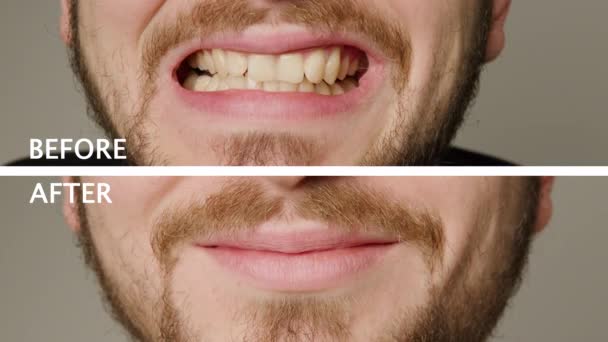 Collage Two Superimposed Pictures Background White Writing Mans Teeth Teeth — Wideo stockowe