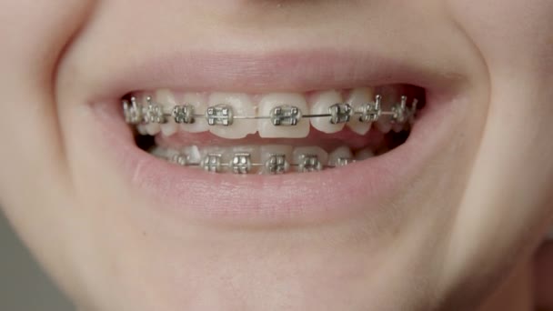 Pojęcie Ortodontycznego Leczenia Stomatologicznego Kobieta Zdrowymi Zębami Uchwyty Ceramiczne Metalowe — Wideo stockowe