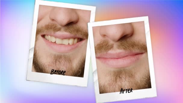 人間の歯の前後に着色された背景に2枚の写真のコラージュ 歯のホワイトニング治療の概念 歯の洗浄と歯の治療の後に大笑いする男 — ストック動画