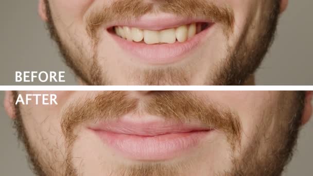 Arka Plan Olmadan Önce Sonra Beyaz Yazıyla Erkek Dişleriyle Üst — Stok video
