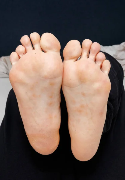 Dyshidrotic eczema on the sole of female feet.