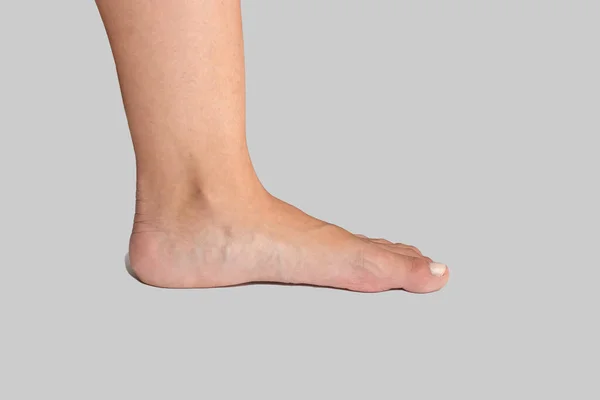Плоская Нога Женщины Отсутствующей Аркой Которая Вызвать Неправильное Выравнивание Ортопедические — стоковое фото