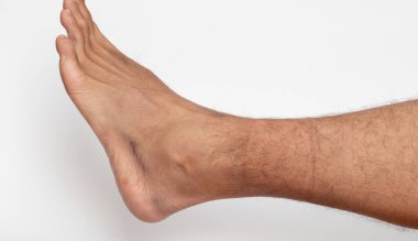 Burkulmuş ayak bileği ve çürük, beyaz arka planda ayak derisinde ezilmiş yara..