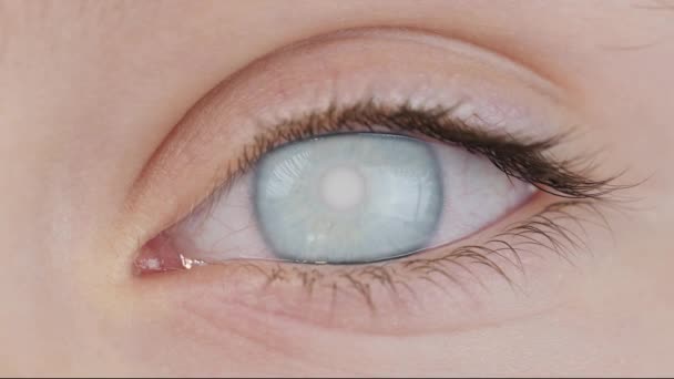 Neprůhlednost Rohovky Lidského Oka Zatažená Oblast Oční Čočce Detailu — Stock video