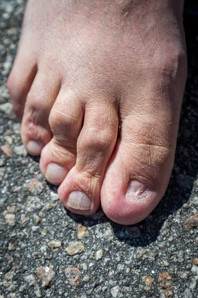 Close Mans Foot Big Toe Nail Missing — Stock Photo, Image