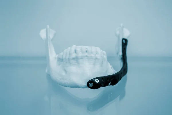 Potištěný Plastový Prototyp Lidské Dolní Čelisti Lékařský Titanový Implantát Zblízka — Stock fotografie