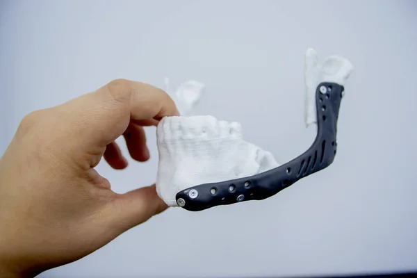 Tenuta Mano Prototipo Plastica Stampata Mascella Inferiore Umana Impianto Medico — Foto Stock