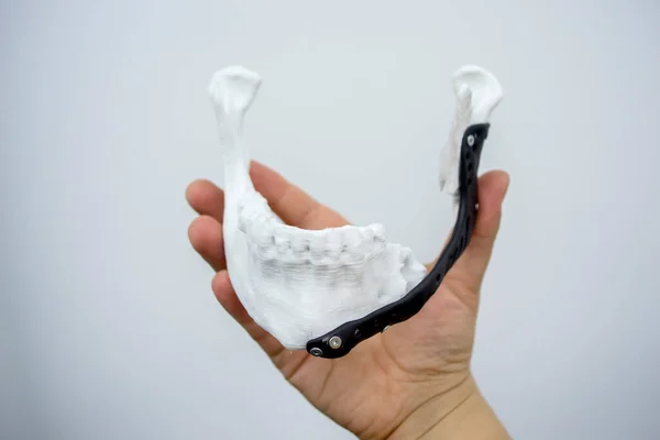 stock image Person holding in hand 3D printed plastic prototype human lower jaw and medical titanium implant close-up. Prosthesis anatomical bone 3D printed from metal powder. Orthopedic maxillo-facial prosthesis