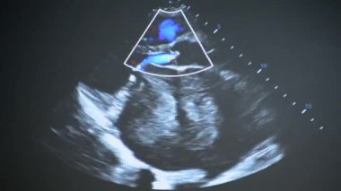 Utrasound image on the monitor close-up. Ultrasound Scan display. Screening Ultrasonography Analysis of person. Ultrasound examination Using Scanner. Ultrasound Scan Device. Echocardiography