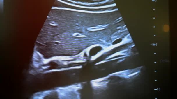 Utrasound Image Monitor Close Ultrasound Scan Display Screening Ultrasonography Analysis — Vídeo de stock