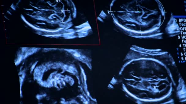 Utrasound Image Monitor Close Ultrasound Scan Display Screening Ultrasonography Analysis — 图库视频影像