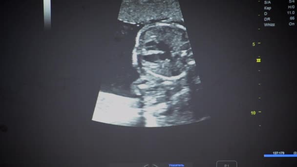 Utrasound Image Monitor Close Ultrasound Scan Display Screening Ultrasonography Analysis — Stockvideo