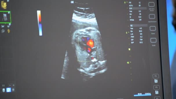 Utrasound Image Monitor Close Ultrasound Scan Display Screening Ultrasonography Analysis — Stock videók