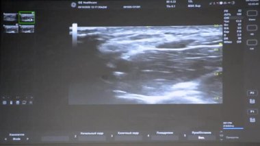 Utrasound image on the monitor close-up. Ultrasound Scan display. Screening Ultrasonography Analysis of person. Ultrasound examination Using Scanner. Ultrasound Scan Device. Echocardiography