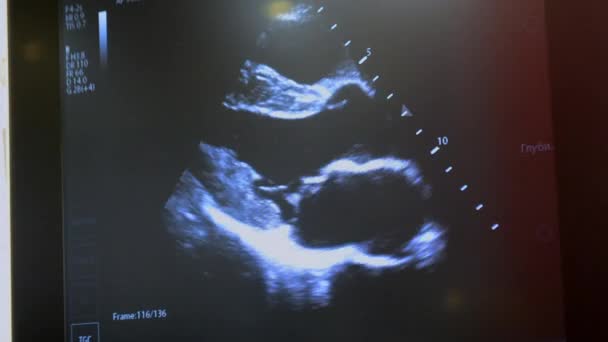 Utrasound Image Monitor Close Ultrasound Scan Display Screening Ultrasonography Analysis — Stok Video