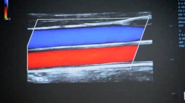 Utrasound image on the monitor close-up. Ultrasound Scan display. Screening Ultrasonography Analysis of person. Ultrasound examination Using Scanner. Ultrasound Scan Device. Echocardiography