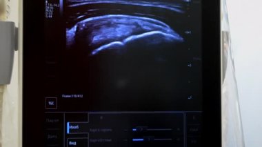 Utrasound image on the monitor close-up. Ultrasound Scan display. Screening Ultrasonography Analysis of person. Ultrasound examination Using Scanner. Ultrasound Scan Device. Echocardiography