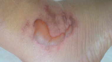 Swollen leg with blisters filled with fluid after frostbite close-up. Swollen foot with fluid-filled blisters from frostbite. Skin swollen in lumps. Foot with bloated. Disease sickness corn callus