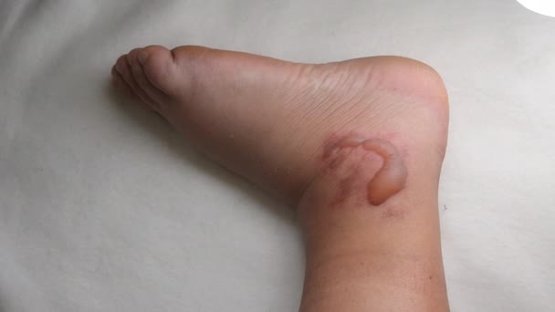 Swollen Leg Blisters Filled Fluid Frostbite Close Swollen Foot Fluid — Stok Video