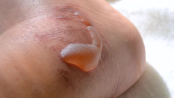 Swollen Leg Blisters Filled Fluid Frostbite Close Swollen Foot Fluid — Stock Video